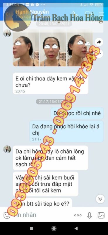 kết quả khách hàng trị mụn ẩn 2021-12-11-9